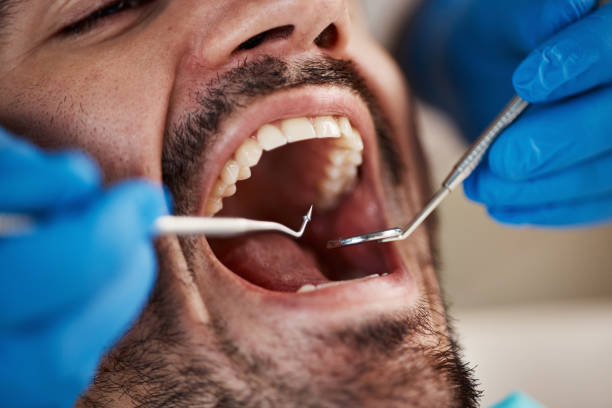 Best Knocked-Out Tooth (Avulsed Tooth) Treatment in Frazer, PA