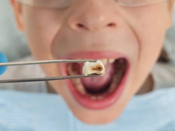 Best Emergency Wisdom Tooth Extraction in Frazer, PA